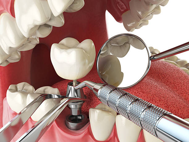 Best Lost Filling or Crown Replacement in Englewood, NJ